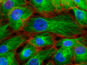 Fluorescence microscopy of stress fibers in breast cancer cells