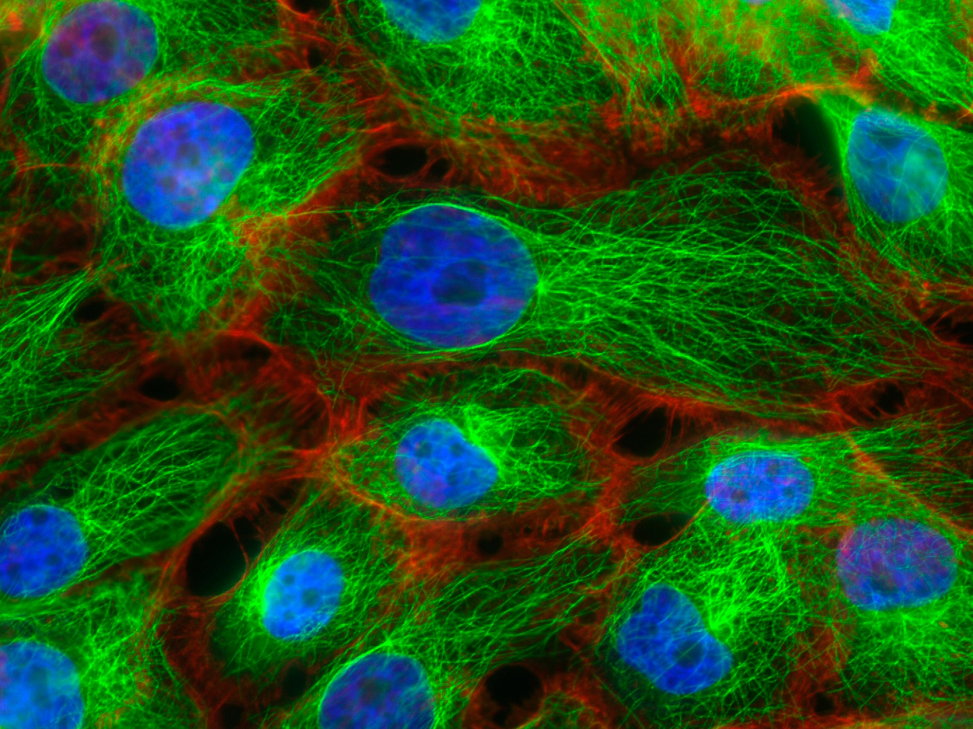 Fluorescence microscopy of stress fibers in breast cancer cells